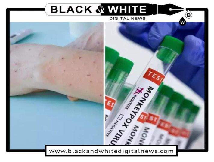 India on High Alert: Understanding Mpox Symptoms and Transmission Amid Rising Concerns